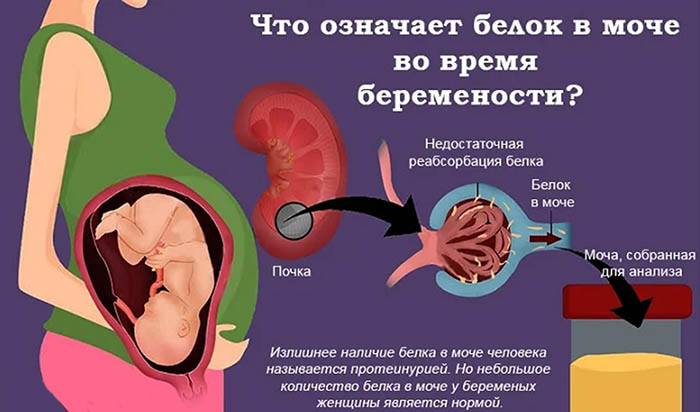 Как снизить белок в моче при беременности в 1-2-3 триместре