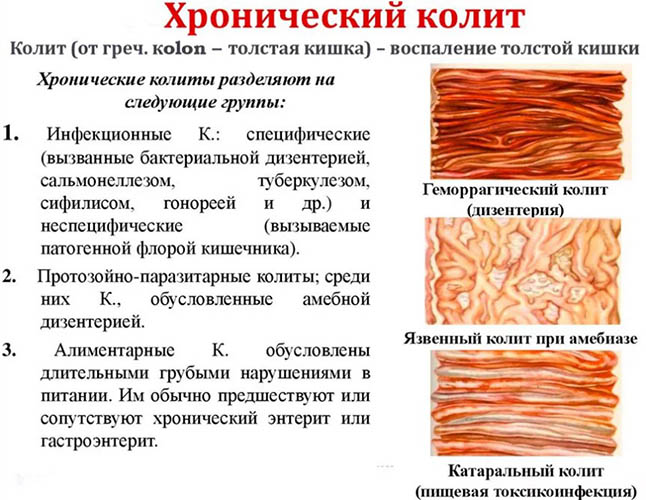 Катаральный проктит. Что это такое, симптомы, лечение