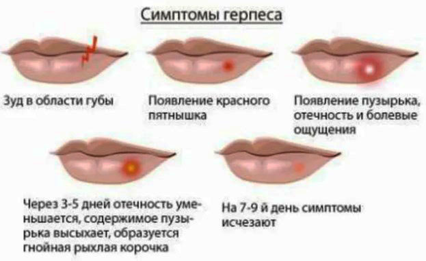 Корвалол от герпеса на губах. Как применять, отзывы