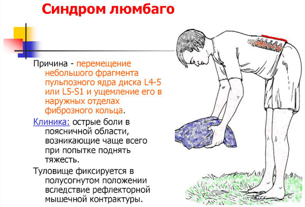 Мышечный спазм в спине, поясничном отделе. Как снять медикаментозно, упражнения