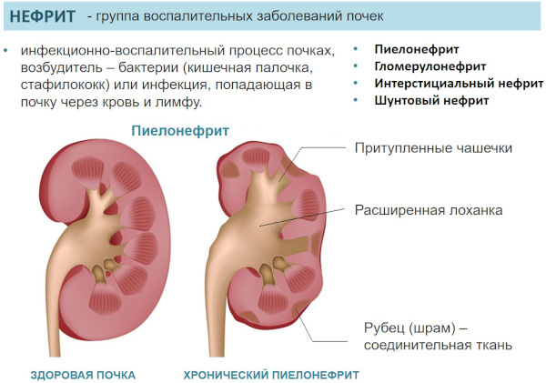 Нефролог. Что за врач, что лечит специалист по почкам