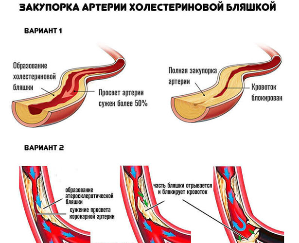 Окклюзия сосудов, артерий нижних конечностей. Что это такое