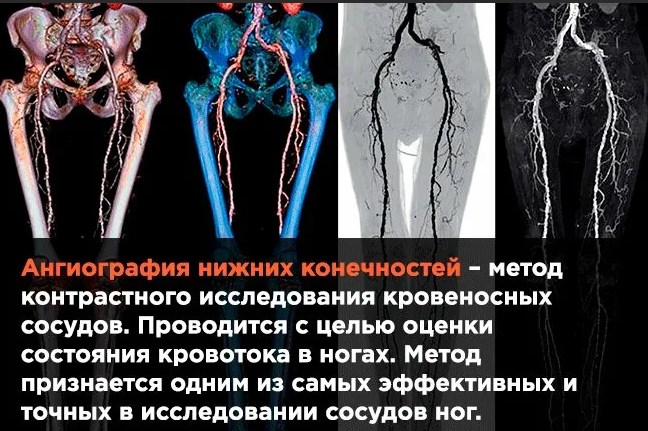 Окклюзия сосудов, артерий нижних конечностей. Что это такое