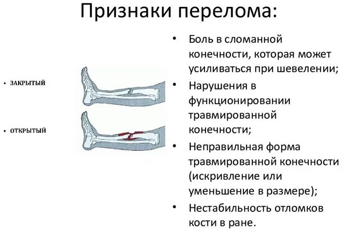 Перелом ноги. Симптомы, признаки, виды: открытый, со смещением