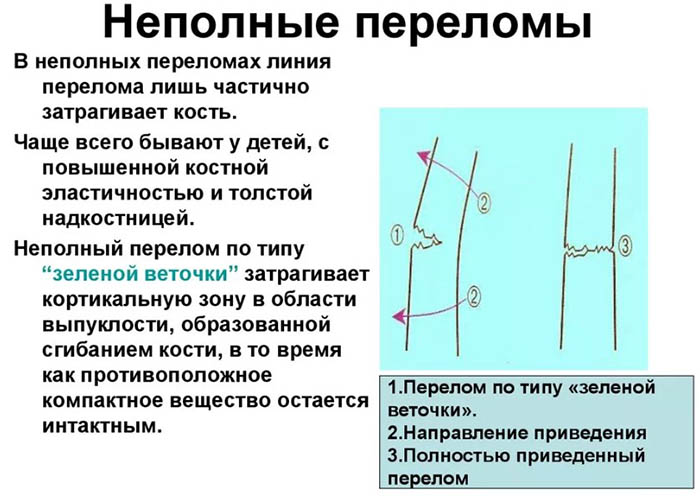 Перелом ноги. Симптомы, признаки, виды: открытый, со смещением