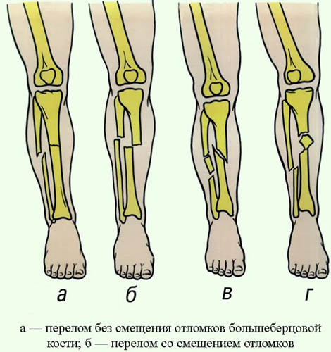 Перелом ноги. Симптомы, признаки, виды: открытый, со смещением