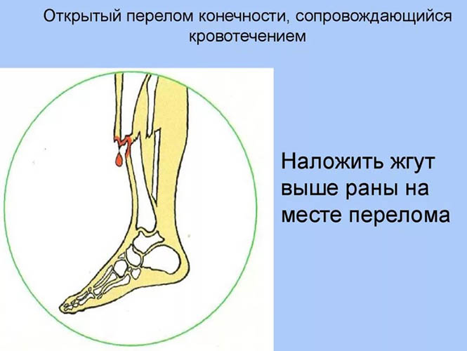 Перелом ноги. Симптомы, признаки, виды: открытый, со смещением