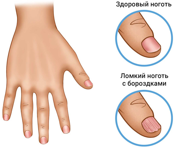 Псориаз ногтей (ониходистрофия) на ногах, руках. Фото, лечение