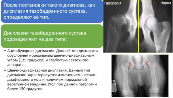 Рентген тазобедренных суставов. Подготовка у взрослых, детей