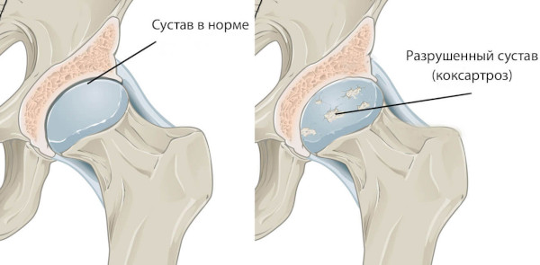 Рентген тазобедренных суставов. Подготовка у взрослых, детей