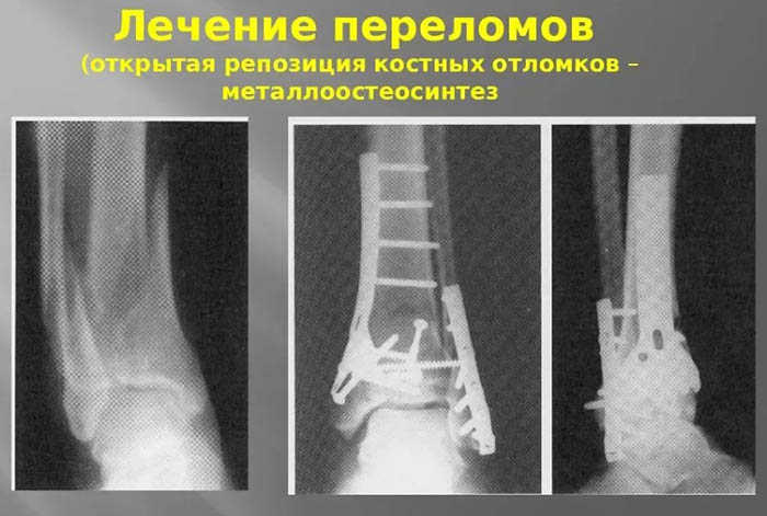 Репозиция костей. Что это такое: закрытая, открытая, техника операции