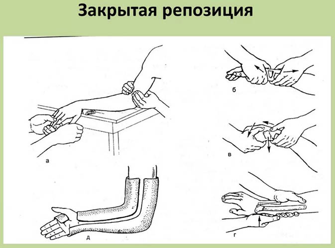 Репозиция костей. Что это такое: закрытая, открытая, техника операции