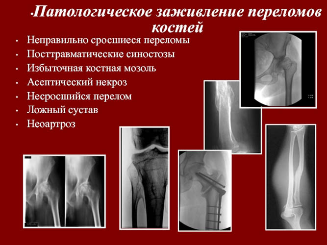 Репозиция костей. Что это такое: закрытая, открытая, техника операции