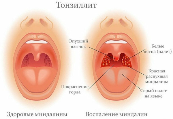 Ревматический полиартрит. Исход, симптомы, лечение, осложнения