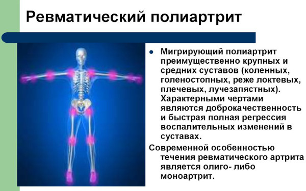 Ревматический полиартрит. Исход, симптомы, лечение, осложнения