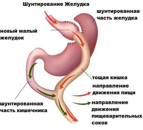 Шунтирование желудка. Что это такое, цена, отзывы при похудении