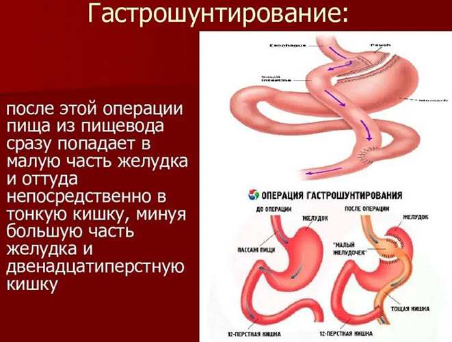 Шунтирование желудка. Что это такое, цена, отзывы при похудении