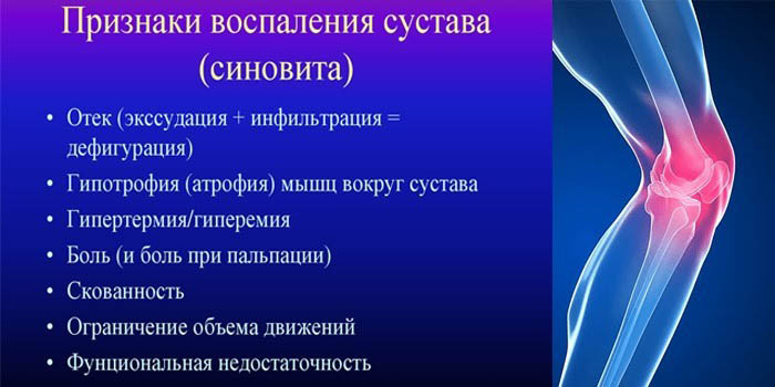 Синовиальная жидкость в коленном суставе (выпот). Лечение, рентген, препараты