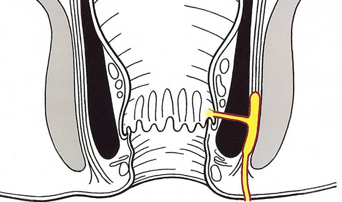 Свищ прямой кишки (заднего прохода, анальный). Симптомы, фото, лечение