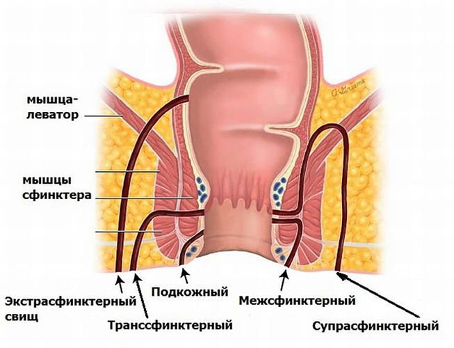 Свищ прямой кишки (заднего прохода, анальный). Симптомы, фото, лечение