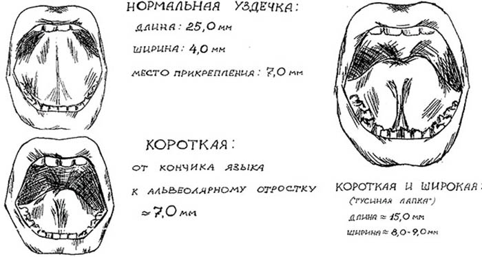 Короткая Уздечка Губы Фото