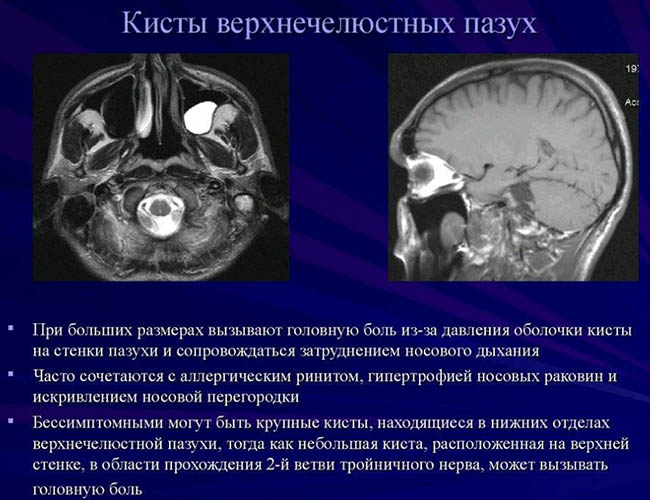 Верхнечелюстная киста пазухи левой, правой, верхней. Что это такое