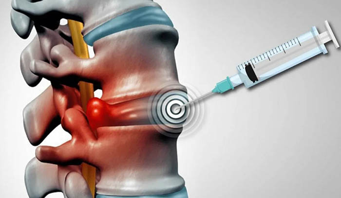 Блокада позвоночника при грыже. Что это такое, цена, отзывы