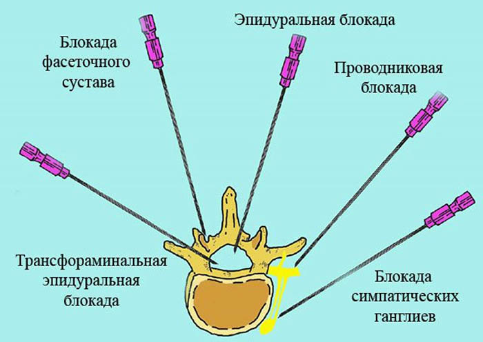 Блокада позвоночника при грыже. Что это такое, цена, отзывы