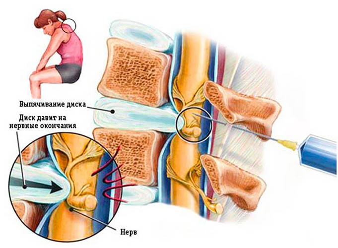 Блокада позвоночника при грыже. Что это такое, цена, отзывы
