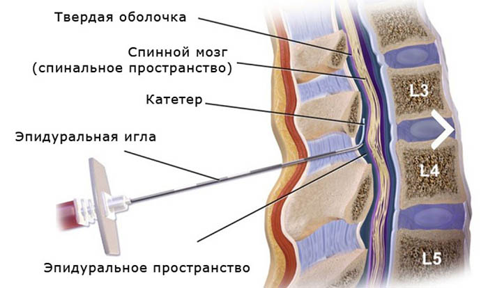 Блокада позвоночника при грыже. Что это такое, цена, отзывы