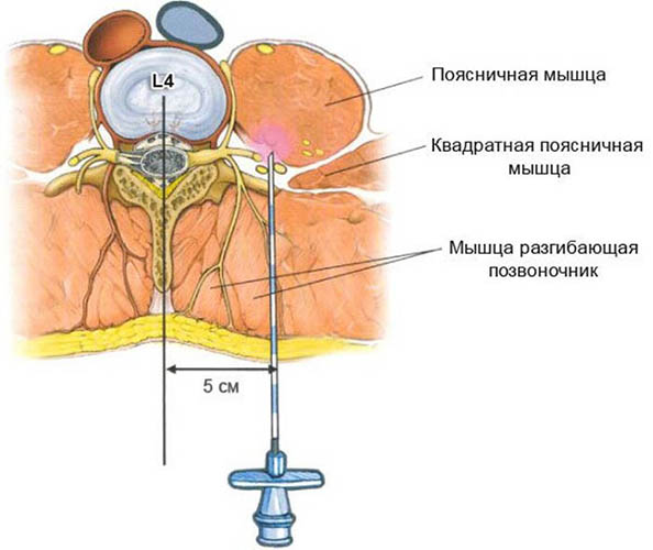 Блокада позвоночника при грыже. Что это такое, цена, отзывы