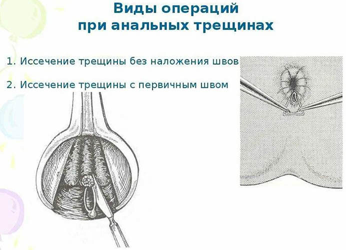 Иссечение анальной трещины. Операция, цена, как происходит