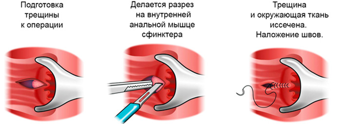 Иссечение анальной трещины. Операция, цена, как происходит