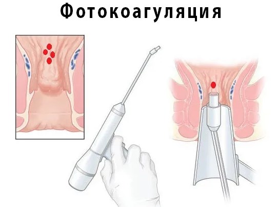 Иссечение анальной трещины. Операция, цена, как происходит