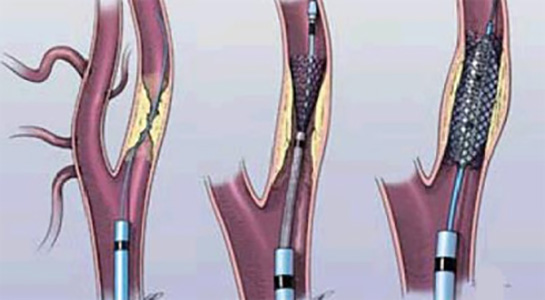 Стентирование сосудов эндоваскулярное. Эндоваскулярная катетерная тромбэктомия вен нижних конечностей. Шунтирование сосудов сердца стент. Стентирование подвздошной вены.