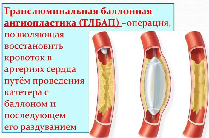 Реканализация. Что это такое: тромба, вен, сосудов