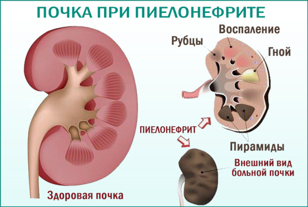 Дискомфорт в мочеиспускательном канале у женщин. Уретральный синдром