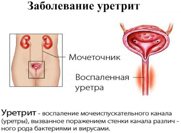 Дискомфорт в мочеиспускательном канале у женщин. Уретральный синдром