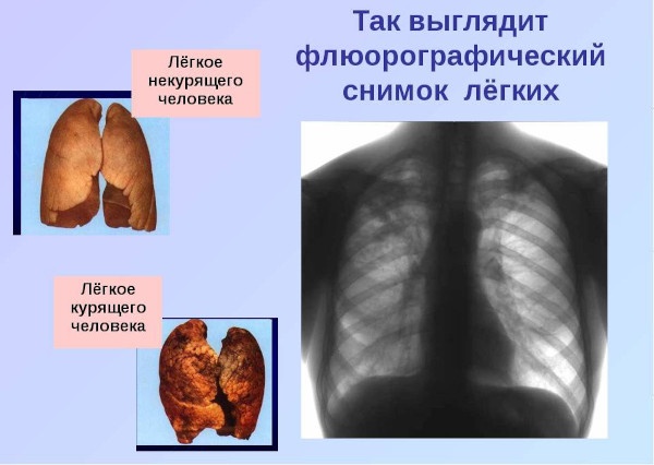 Флюорография. Противопоказания