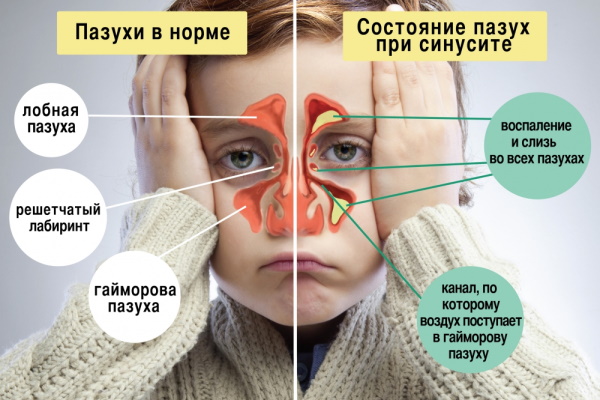 Гайморит у детей. Симптомы, признаки, лечение у ребенка