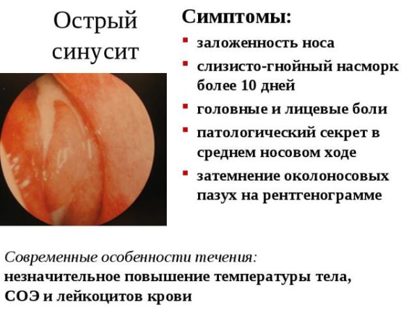 Гайморит у детей. Симптомы, признаки, лечение у ребенка