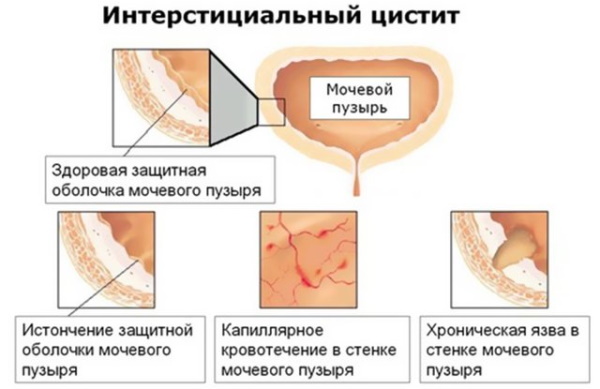 Интерстициальный цистит у женщин. Симптомы и лечение