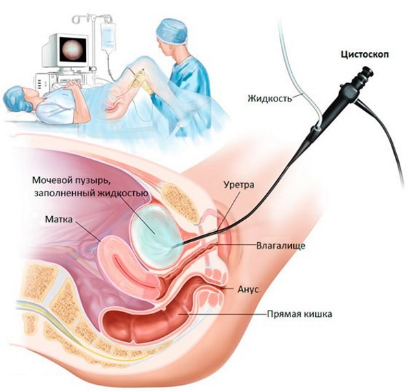 Интерстициальный цистит у женщин. Симптомы и лечение