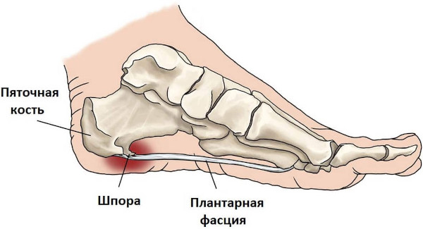 Лечение пяточной шпоры Витафоном. Инструкция, отзывы