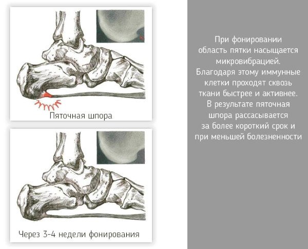 Лечение пяточной шпоры Витафоном. Инструкция, отзывы