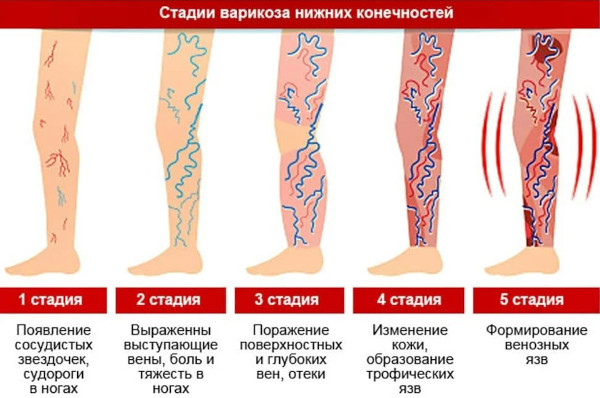 Лечение варикоза лазером (операция по удалению). Цена