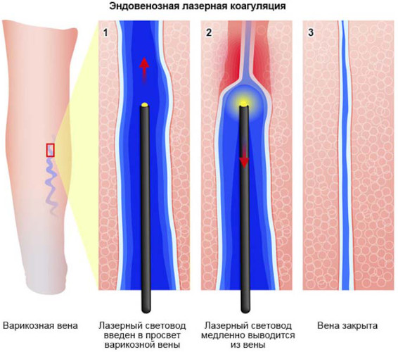 Лечение варикоза лазером (операция по удалению). Цена