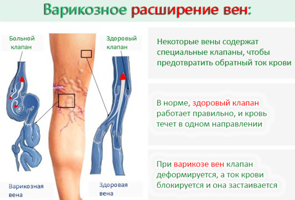 Лечение варикоза лазером (операция по удалению). Цена