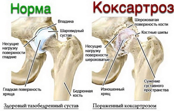 Массаж тазобедренного сустава и ягодичной области при артрозе, коксартрозе