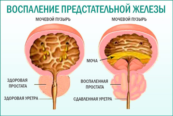 Обезболивающие при простатите у мужчин. Что делать, если болит простата